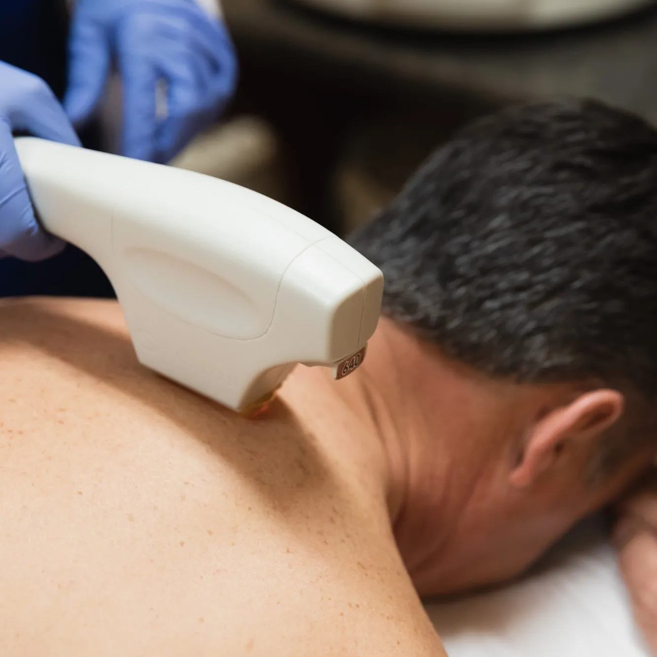 Man receiving Forever Bare BBL treatment on his back.